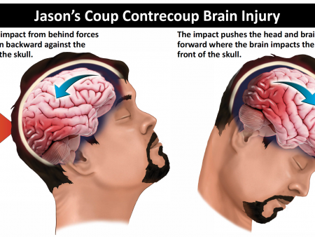 Jason’s Coup Contrecoup Brain Injury v1