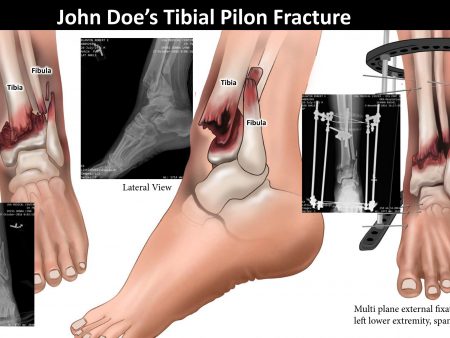 John Doe Injuries