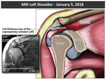MRI Left Shoulder - v2
