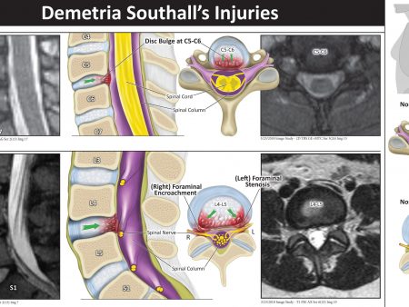 Southall Injuries_v2